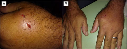 Figure 1. A. Perforated lesion caused by the stinger. B. Remarkable edema of his left hand.